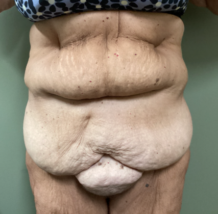 Body Contouring: Case 1 - Before