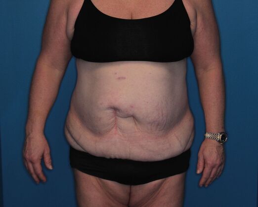 Body Contouring: Case 2 - Before