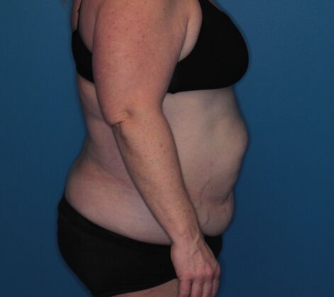 Body Contouring: Case 2 - Before