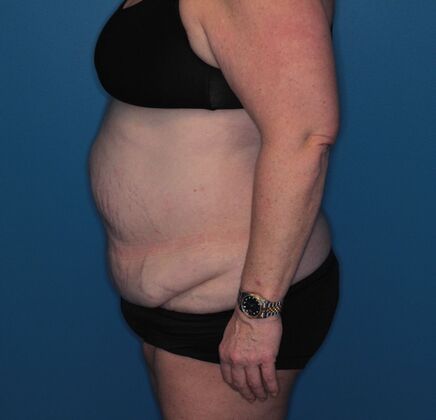 Body Contouring: Case 2 - Before