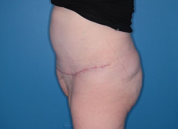 Body Contouring: Case 2 - After