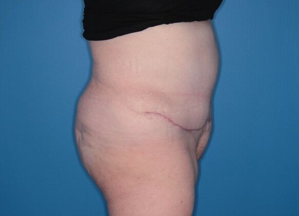 Body Contouring: Case 2 - After