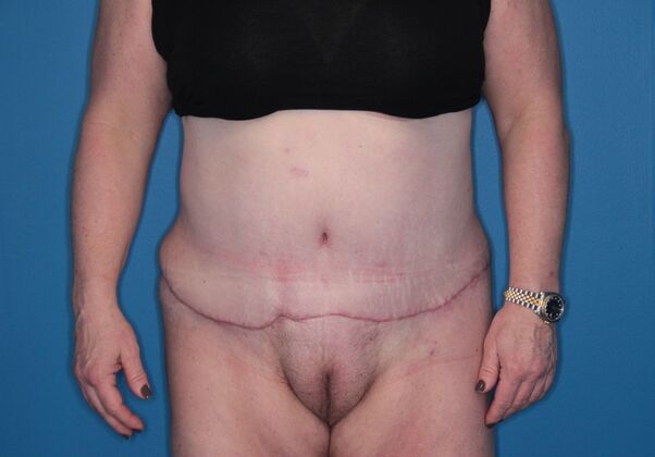 Body Contouring: Case 2 - After (Early Recovery)