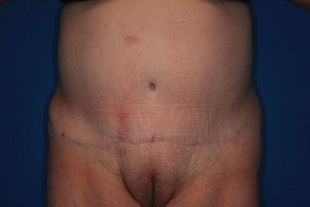 Body Contouring: Case 2 - After