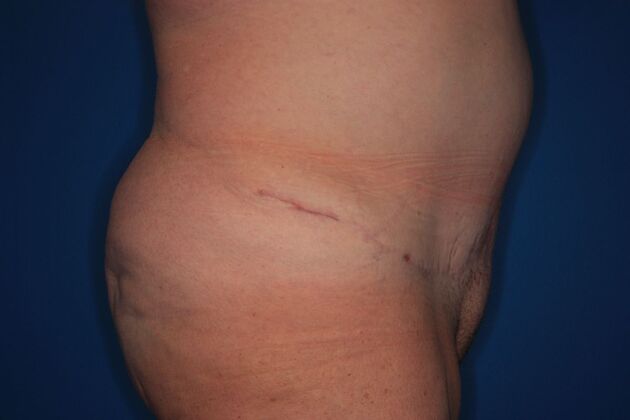 Body Contouring: Case 2 - Before