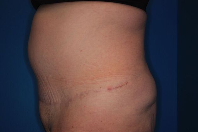 Body Contouring: Case 2 - After