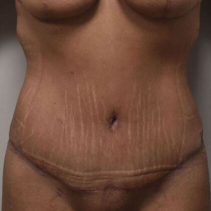 Tummy Tuck (Abdominoplasty): Case 434 - After