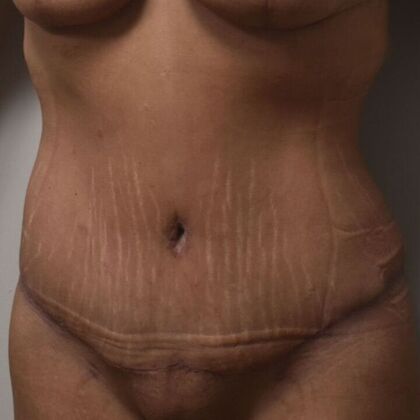 Tummy Tuck (Abdominoplasty): Case 434 - After