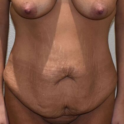 Tummy Tuck (Abdominoplasty): Case 434 - Before