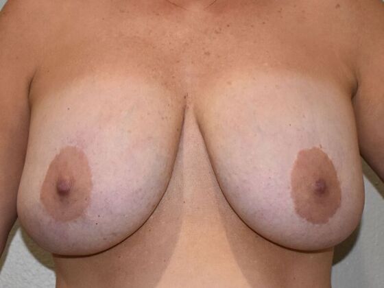 Breast Implant Removal: Case 35 - Before
