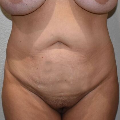Tummy Tuck (Abdominoplasty): Case 435 - Before