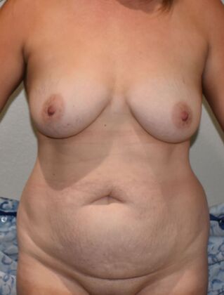 Mommy Makeover Case 285 - Before