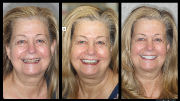 Smile Makeover Brooklyn, NY : Smile Makeover Full Mouth Rehab Bay Ridge, NY - Before