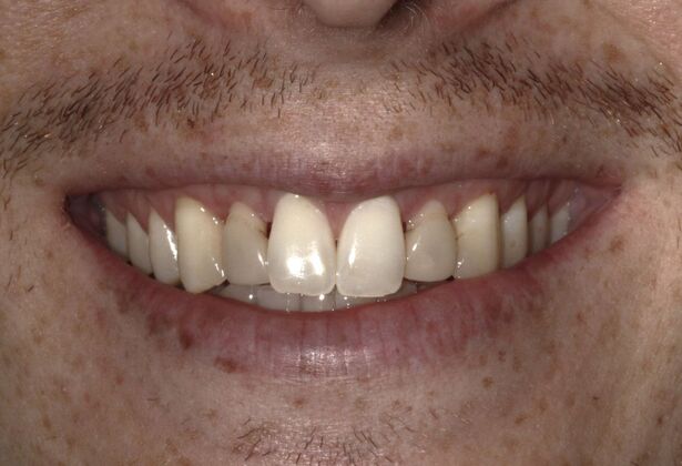Smile Makeover Brooklyn, NY : Smile Makeover Veneers and In-Office Bleaching Bay Ridge, NY - Before