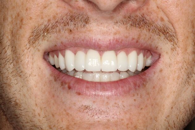Smile Makeover Brooklyn, NY : Smile Makeover Veneers and In-Office Bleaching Bay Ridge, NY - After