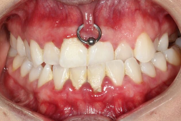 Smile Makeover Brooklyn, NY : Smile Makeover Clear Aligner Therapy Bay Ridge, NY - Before