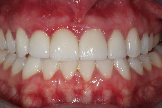 Smile Makeover Brooklyn, NY : Smile Makeover Clear Aligner Therapy Bay Ridge, NY - After