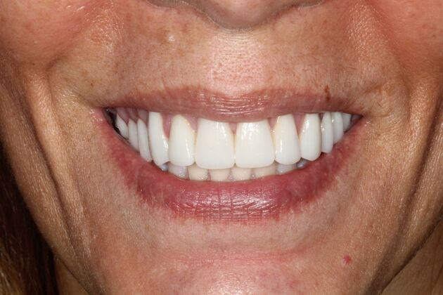 Smile Makeover Brooklyn, NY  Smile Makeover Twelve-Restorations Bay Ridge, NY - After