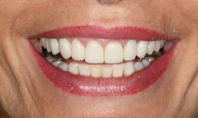 Smile Makeover Brooklyn, NY  Smile Makeover Bay Ridge, NY - After