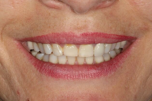 Smile Makeover Brooklyn, NY  Smile Makeover Bay Ridge, NY - Before