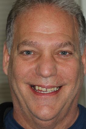 All-on-4 Dental Implants Brooklyn, NY Case 5 - Before