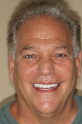 All-on-4 Dental Implants Brooklyn, NY Case 5 - After