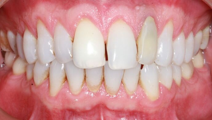 Smile Makeover Brooklyn, NY  Smile Makeover Beautiful Teeth Bay Ridge, NY - Before