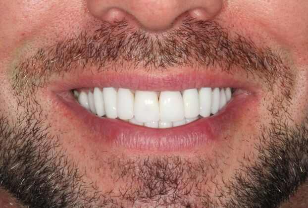 Smile Makeover Brooklyn, NY : Smile Makeover Beautiful Teeth Bay Ridge, NY - After Beautiful Smile