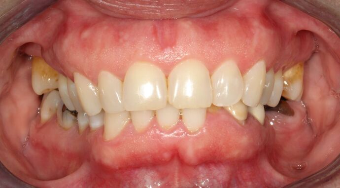 Full Mouth Reconstruction Brooklyn NY Case 6 - Before