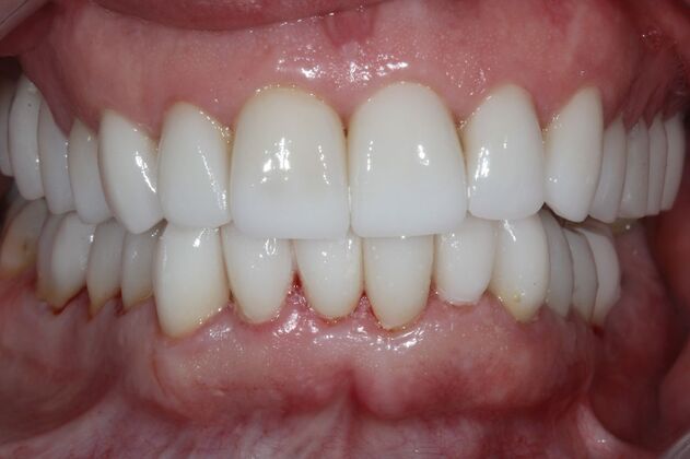 Full Mouth Reconstruction Brooklyn NY Case 6 - After