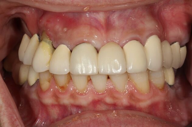 Full Mouth Reconstruction Brooklyn NY Case 7 - Before