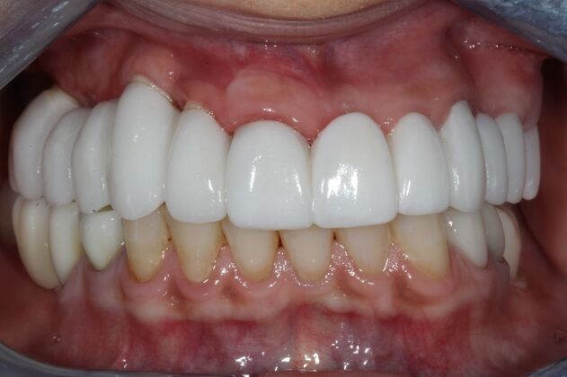 Full Mouth Reconstruction Brooklyn NY Case 7 - After