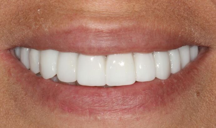 Full Mouth Reconstruction Brooklyn NY: Case 7 - After