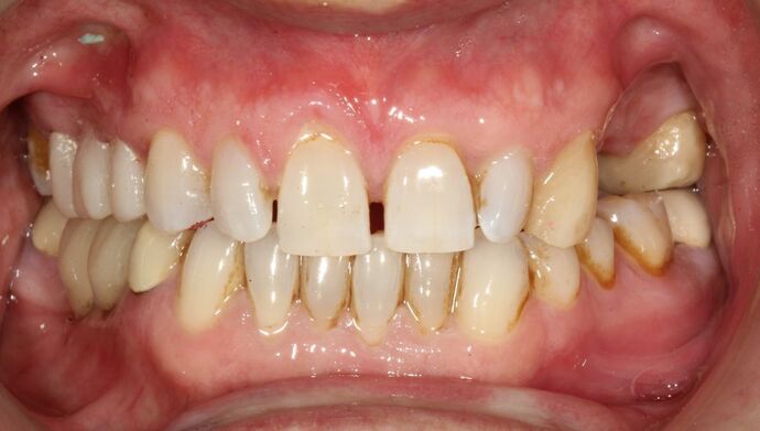 Full Mouth Reconstruction Brooklyn NY Case 8 - Before
