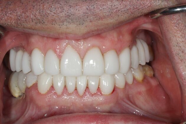 Full Mouth Reconstruction Brooklyn NY Case 8 - After