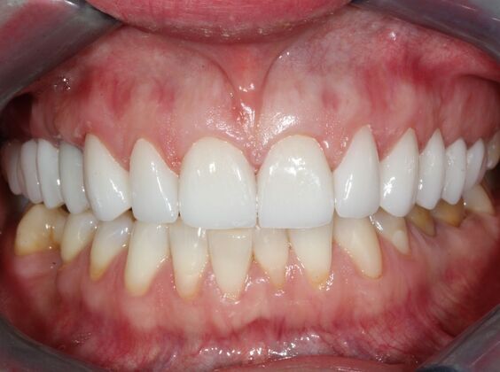 Full Mouth Reconstruction Brooklyn NY Case 9 - After