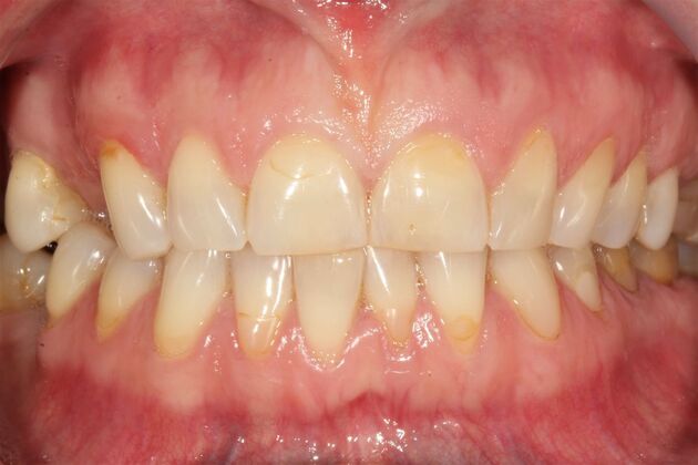 Full Mouth Reconstruction Brooklyn NY Case 9 - Before