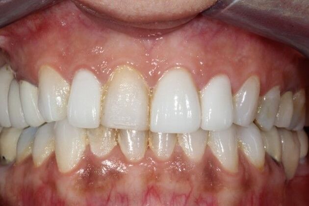 Full Mouth Reconstruction Brooklyn NY Case 10 - Before