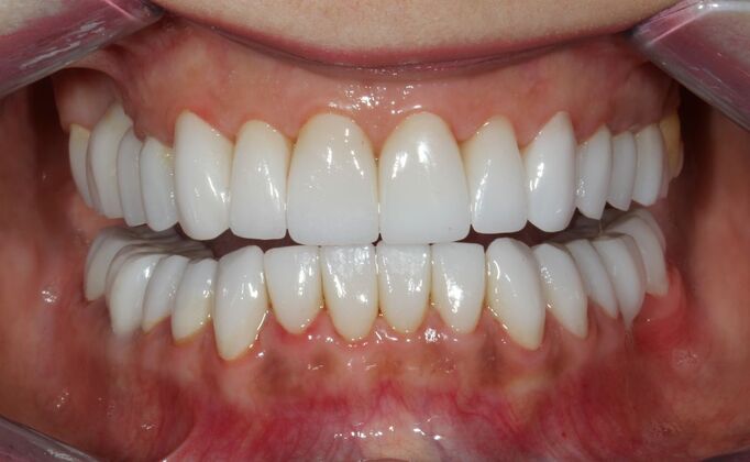 Full Mouth Reconstruction Brooklyn NY: Case 10 - Definitive Full Mouth Rehabilitation