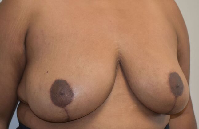 Breast Reduction: Case 166 - After