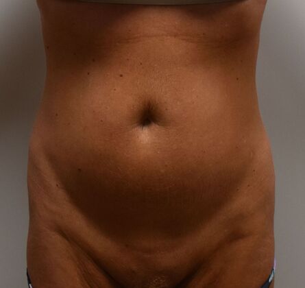 Tummy Tuck (Abdominoplasty): Case 437 - Before