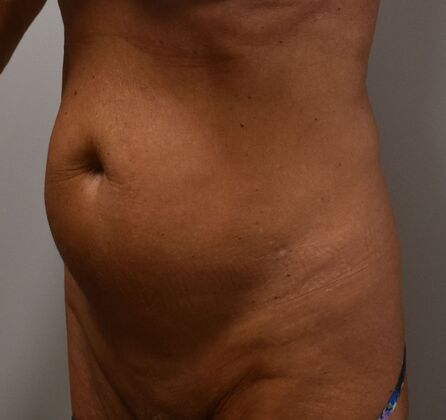 Tummy Tuck (Abdominoplasty): Case 437 - Before