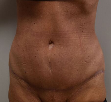 Tummy Tuck (Abdominoplasty): Case 437 - After