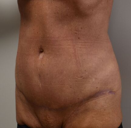 Tummy Tuck (Abdominoplasty): Case 437 - After