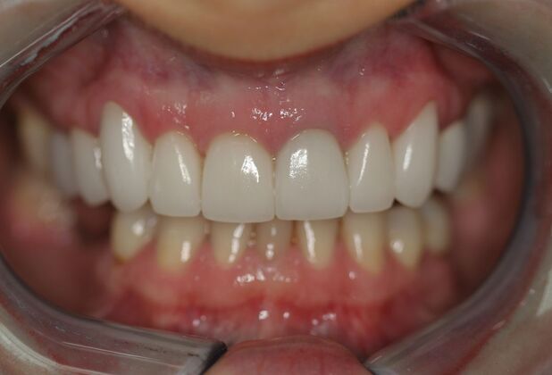 Smile Makeover Brooklyn, NY : Smile Makeover Smile Enhancement Bay Ridge, NY - After