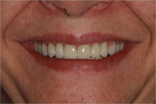 Smile Makeover Brooklyn, NY : Smile Makeover Worn Chipped Teeth - After