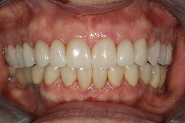 Smile Makeover Brooklyn, NY : Smile Makeover Worn Chipped Teeth - After