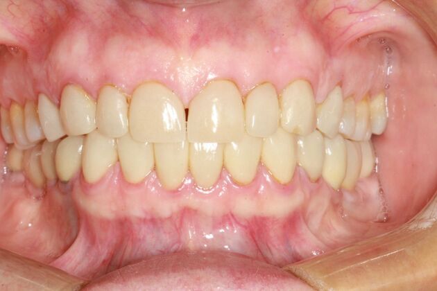 Smile Makeover Brooklyn, NY : Smile Makeover Worn Chipped Teeth - Before