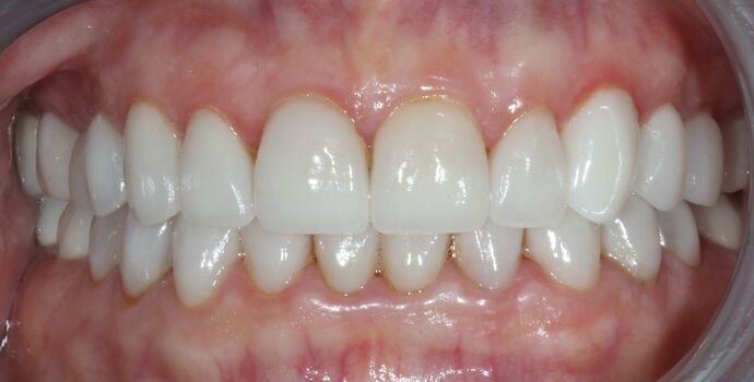 Full Mouth Reconstruction Brooklyn NY: Case 11 - After