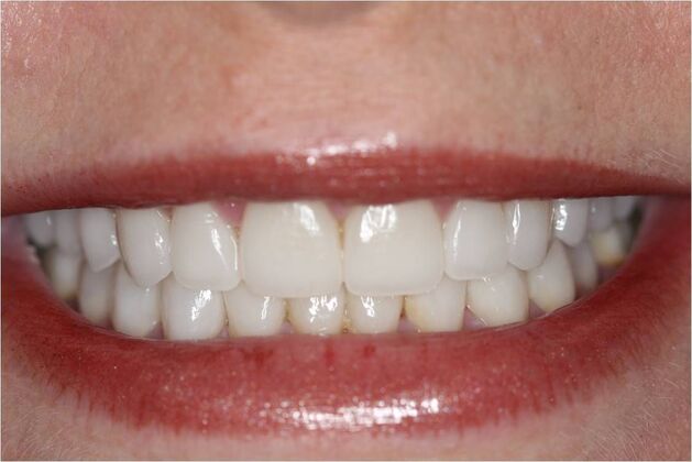 Full Mouth Reconstruction Brooklyn NY: Case 11 - After